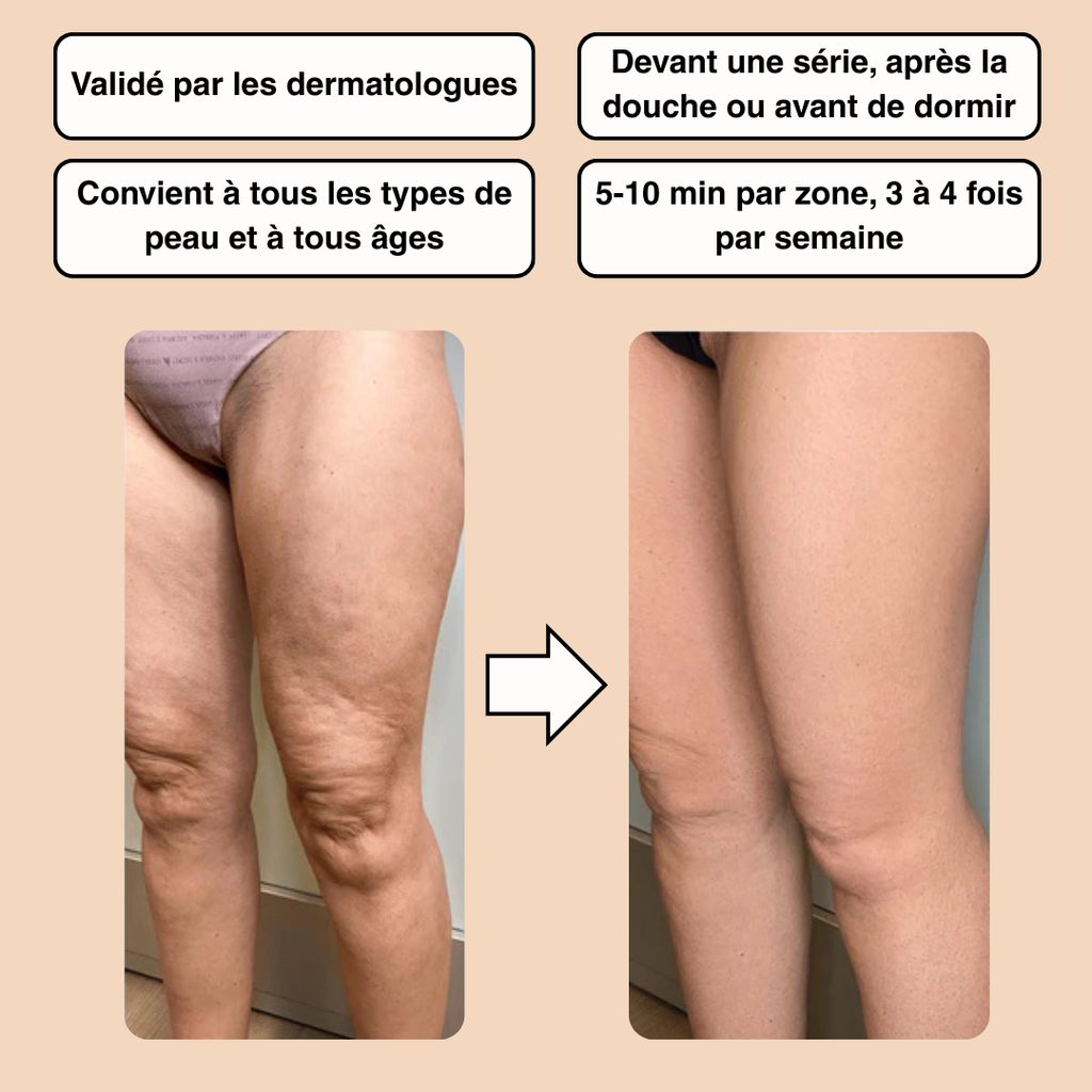 Masseur Anticellulite Nerah